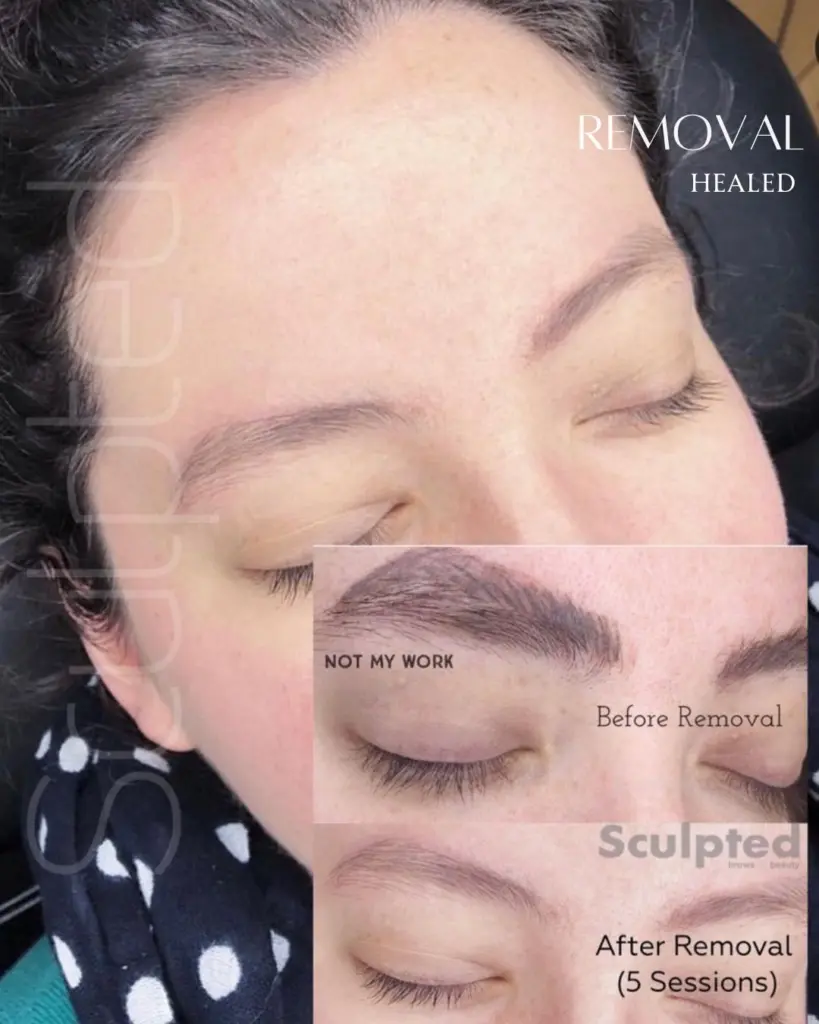 Person with permanent makeup eyebrow removal