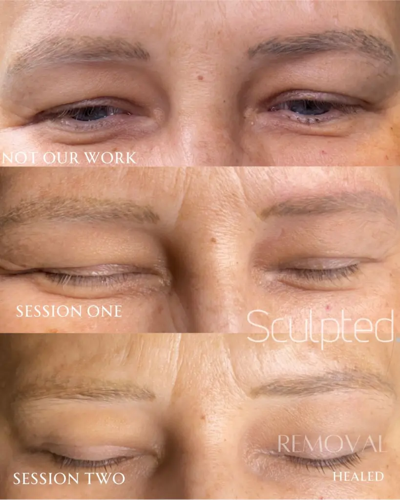 permanent makeup removal done on the eyebrows at Sculpted NYC