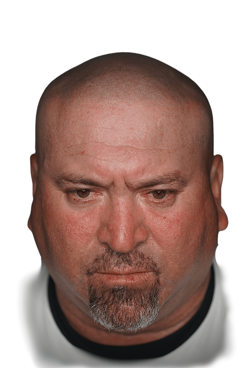 51 year old man with SMP, scalp micropigmentation hair tattoo with natural results