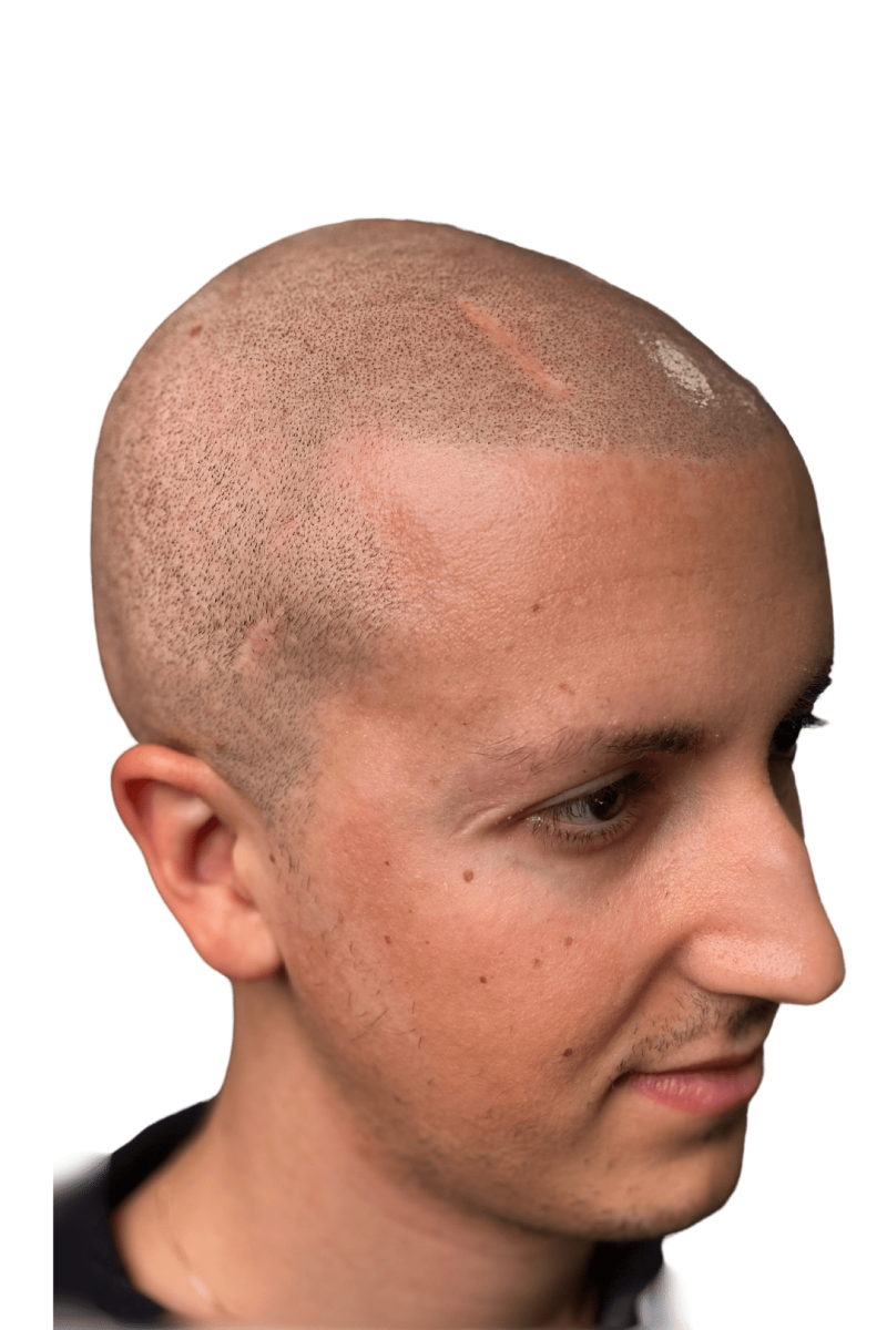young man with brain injury scar fixed with Scalp micropigmentation.