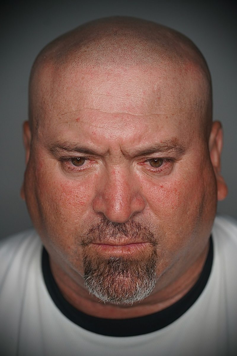 52 year old with Scalp Micropigmentation (SMP) or hair tattoo